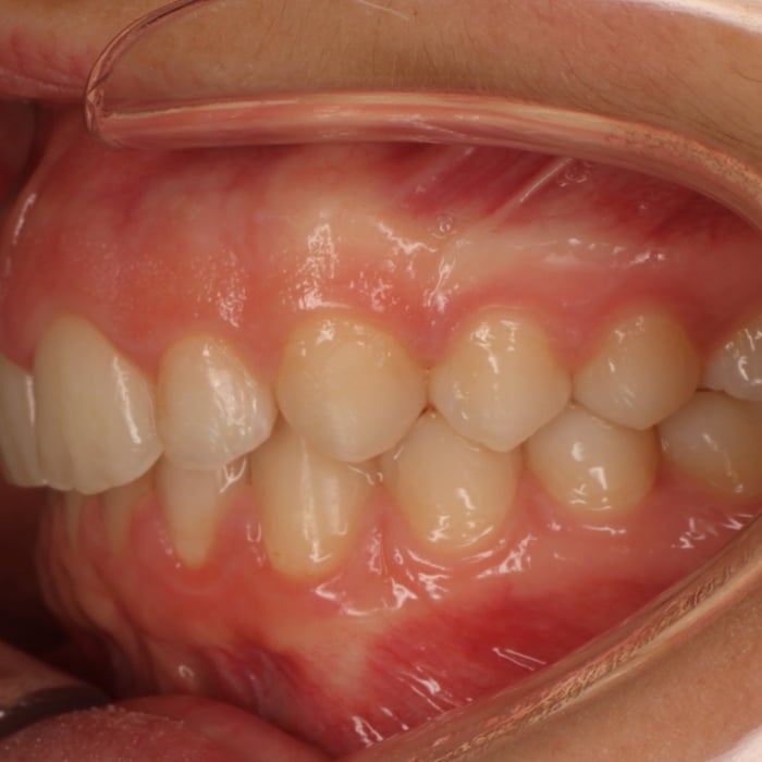 Cas real: ortodòncia invisible amb Invisalign
