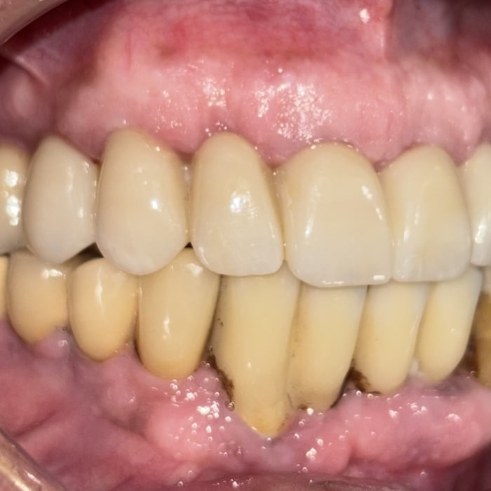 Rehabilitació oral superior amb implants i pròtesi fixa immediata