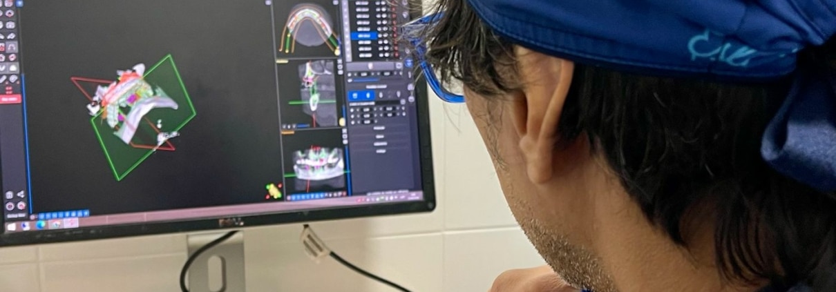 Implants dentals amb cirurgia guiada