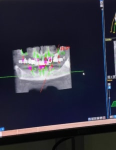 Implants dentals amb cirurgia guiada